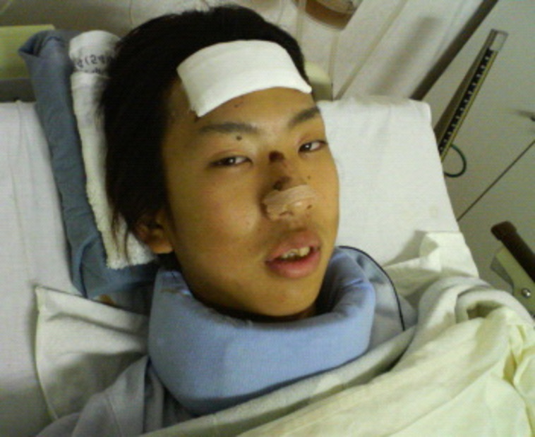 【写真】事故直後の入院している時のみよたつやさん。額には包帯がまかれ、首も固定されている。表情はうつろげで、鼻には事故当時にできたと思われる傷がみえる。